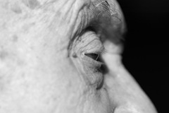 alzheimer